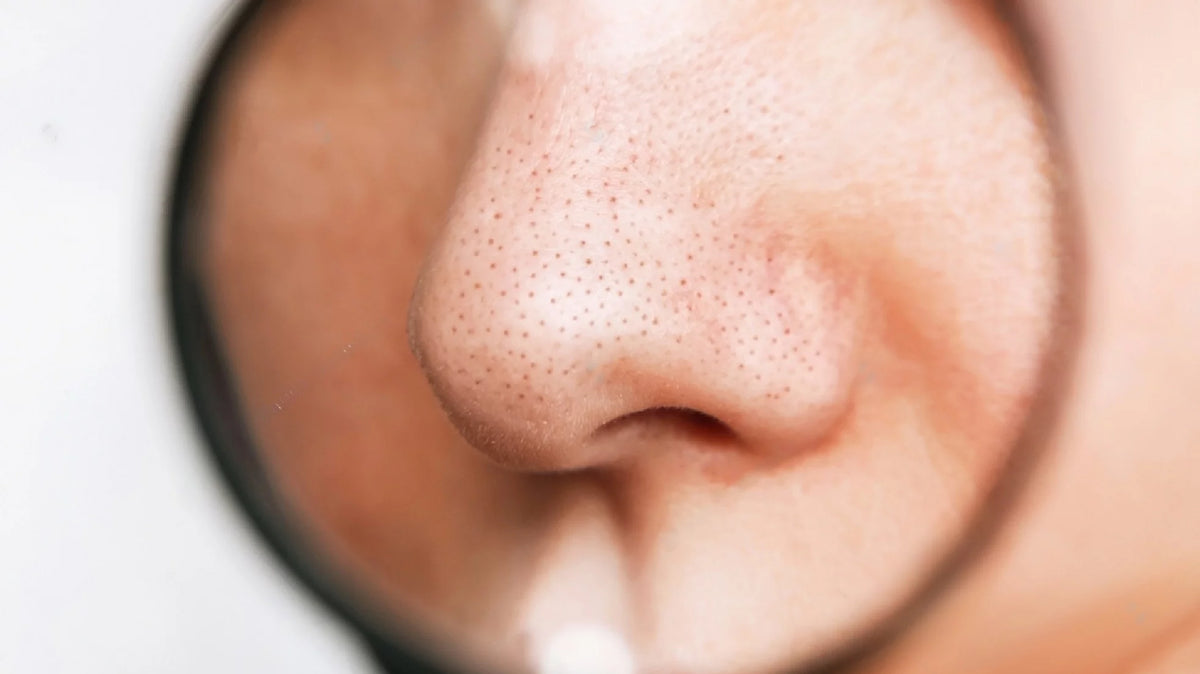 SAY GOODBYE TO BLACKHEADS!